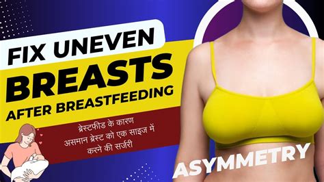 Fix Uneven Breasts After Breastfeeding Breast Asymmetry Surgery Fat