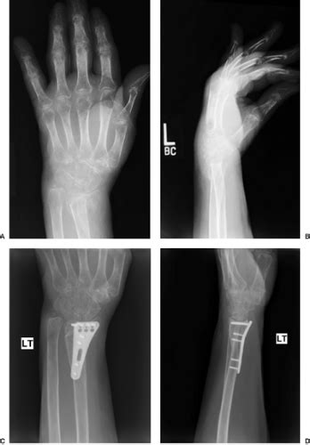 Distal Radius Osteotomy | Musculoskeletal Key