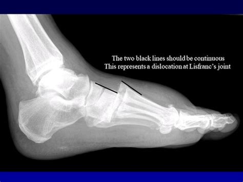 What is a Lisfranc injury and how come it sidelines athletes for so ...