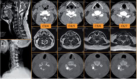 Figure 1 From Modified Expansive Laminoplasty And Fusion Compared With