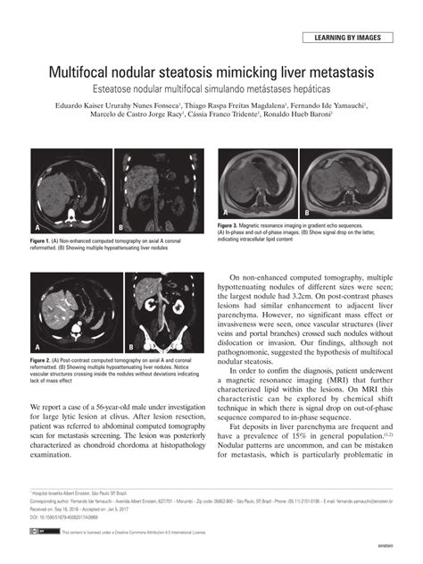 Pdf Multifocal Nodular Steatosis Mimicking Liver Metastasis