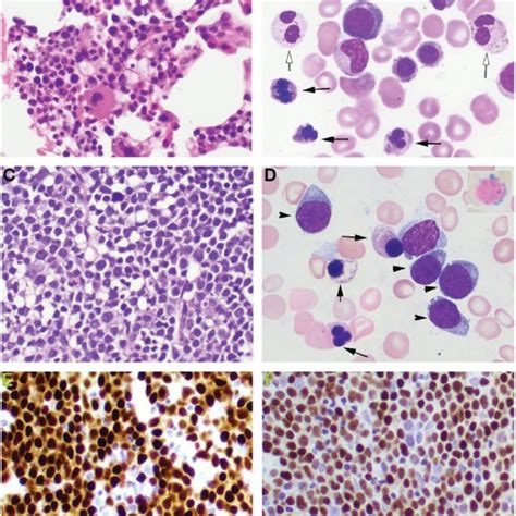 Morphologic Features Of Case 1 A And B Bone Marrow At The Download Scientific Diagram