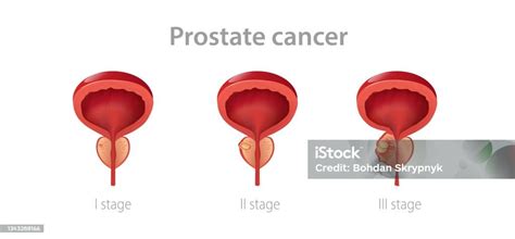 Stages Prostate Cancer Disruption Of Male Gland With Its Growth Into