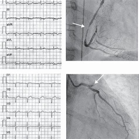 Left panels display a 12-lead ECG recorded during persistent chest ...