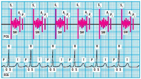 Systolic Murmurs Thoracic Key