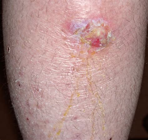 Diabetic Rash On Lower Leg