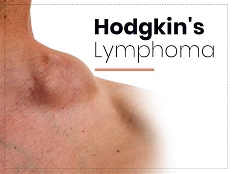 Hodgkin's Lymphoma: Types, Symptoms, Causes, Risk Factors, Diagnosis, Stages, And Treatment ...