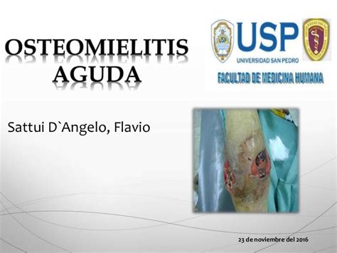 Osteomielitis Aguda