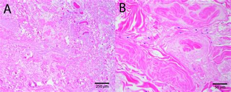 Surgical Excision Of Perineal Nodular Induration A Cyclists Third