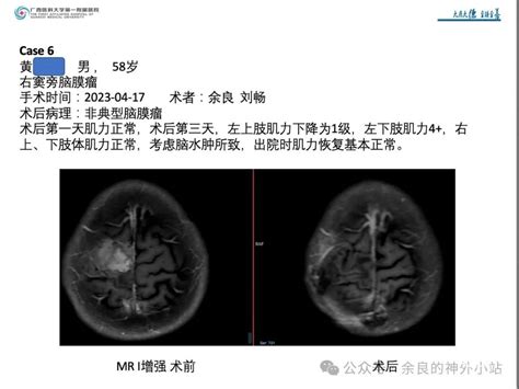 纵裂入路及镰旁脑膜瘤的手术治疗 脑医汇 神外资讯 神介资讯