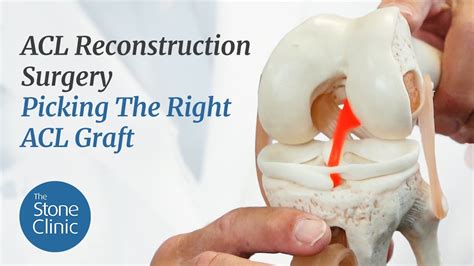 Acl Reconstruction Surgery Explained And Picking The Right Acl Graft Youtube