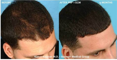 36-Year-Old Male PRP Hair Regrowth | Bauman Medical Group