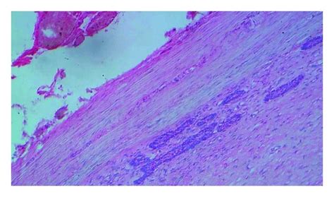 Photomicrograph Showing Strands Of Odontogenic Epithelium Near The