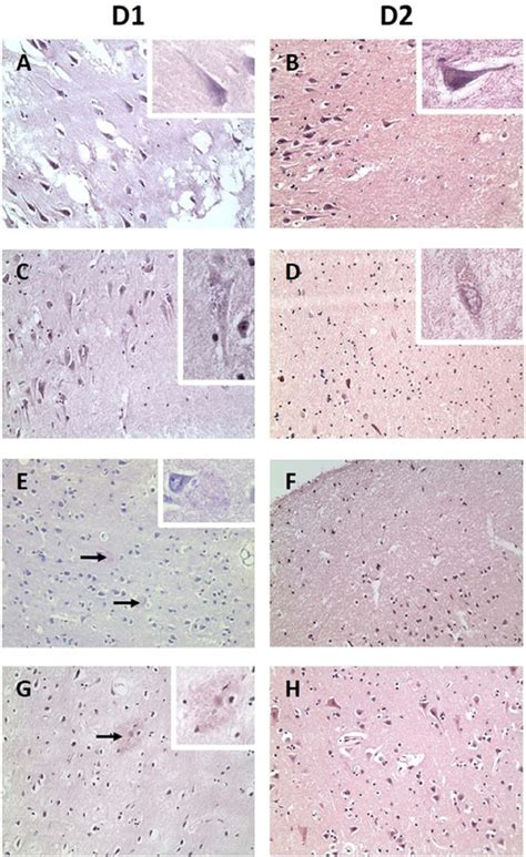 AD related pathology in D1 and D2. H&E staining shows neurofibrillary ...