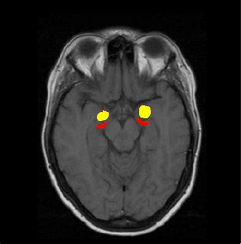 Amygdala Mri Anatomy