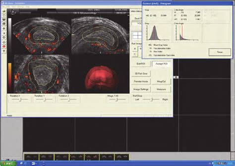 Vascularization Of The Subendometrial Area By 3d Power Doppler 3d