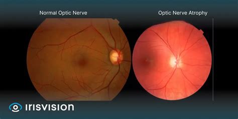 What Diseases Cause Optic Atrophy Irisvision