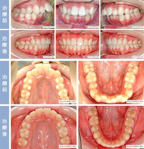 出っ歯・上顎前突 女医が担当する咬み合わせを重視した舌側矯正裏側矯正 歯列矯正の高田馬場矯正歯科