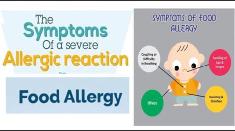 The Most Common Allergy In The World Types Of Allergens Signs And