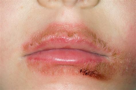 Dermatitis Around The Mouth Photograph By Dr P Marazzi Science Photo