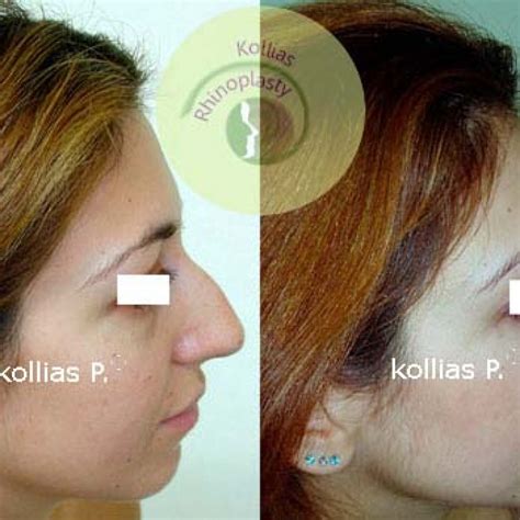 Rhinoplasty Nasal Tip Ptosis 039 Π Κόλλιας