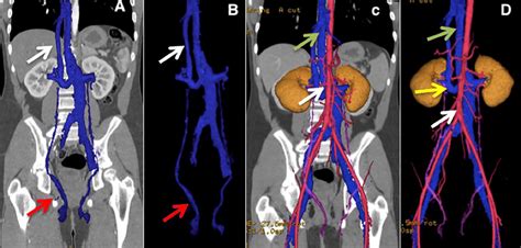 A And B Lower Arrow Shows Testicular Vein Upper Arrow Shows