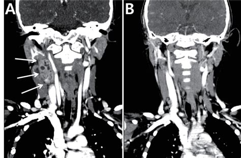 Serial Computerized Tomography Findings A Multiple Conglomerated