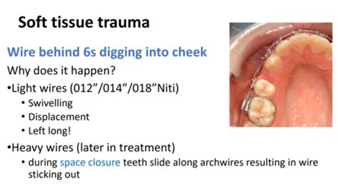 Ortho Tutorial Orthodontic Emergencies Flashcards Quizlet