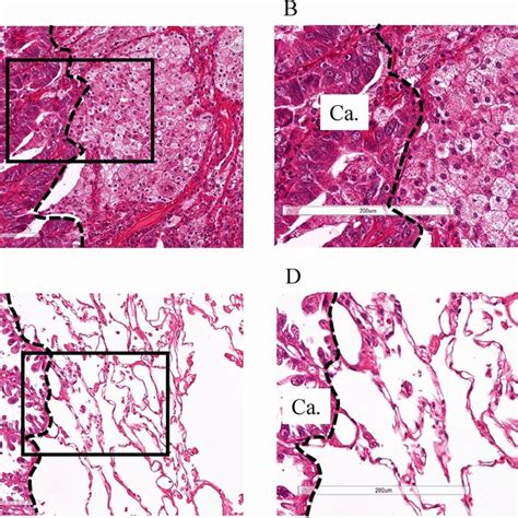 Microscopic Features Of High And Low Peri Tumoral Macrophage Contents