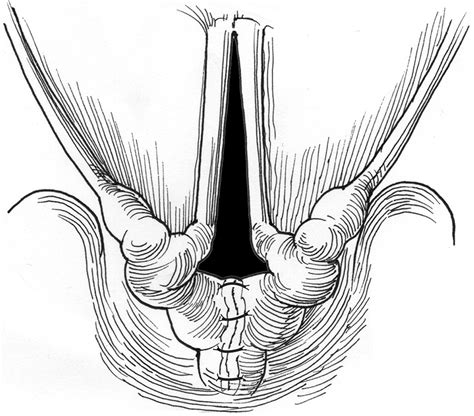 Endoscopic Repair Of Laryngeal Cleft Operative Techniques In Otolaryngology Head And Neck Surgery