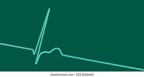 Electrocardiogram Ecg Displaying Junctional Rhythm Which Stock Illustration 2311266663 ...