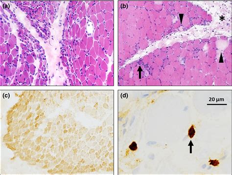 Diagnosis Of Dermatomyositis Autoantibody Profile And Muscle Pathology