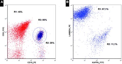 Flow Cytometry Of Mantle Cell Lymphoma In The Peripheral Blood 2015