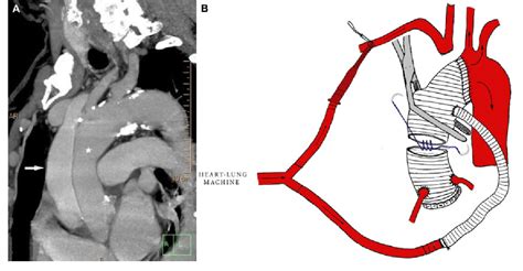 Figure 1 From Surgical Reconstruction Of The Dissected Innominate