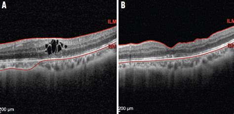 Epiretinal Membrane Grading