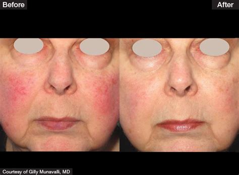 Ipl For Rosacea At Home Scourgedrawing