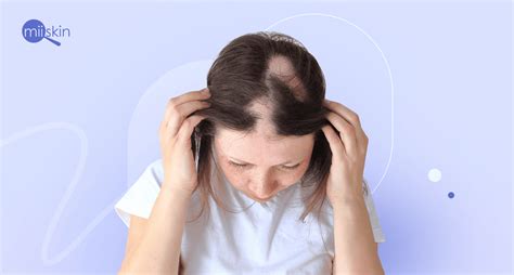 How To Stop Alopecia Areata From Spreading