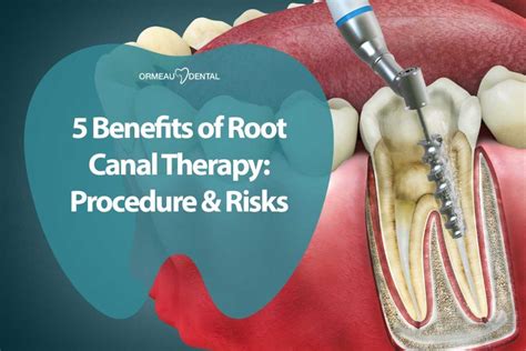 5 Benefits Of Root Canal Therapy Procedure And Risks