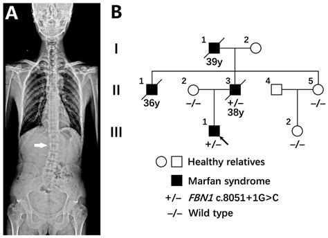 Genes Free Full Text Fbn1 Splice Altering Mutations In Marfan Syndrome A Case Report And