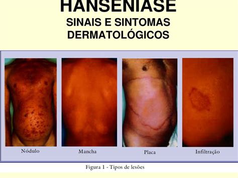 O Que Causa Hanseníase - Sinais E Sintomas Da Hanseníase – SDYEM