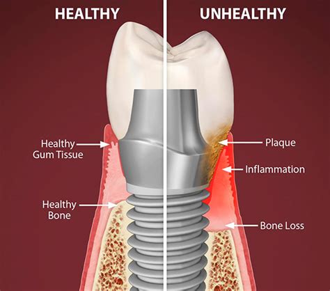 Peri Implantitis Gum Diseases Dental Clinic Crete