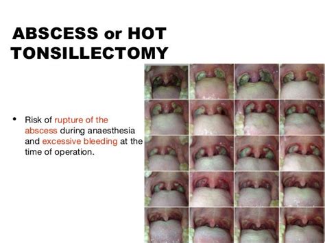 Quinsy Peritonsillar Abscess