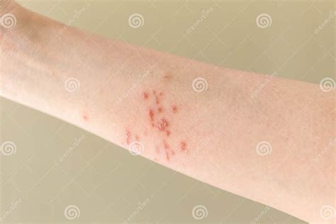 Arm With Psoriasis Stock Image Image Of Dermatology 179036059