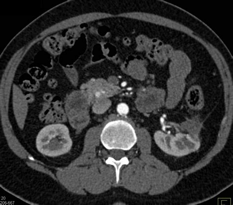 Mm Vascular Metastases From Renal Cell Carcinoma To The Head Of The