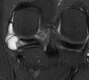 New Observations On Meniscal Cysts Springerlink