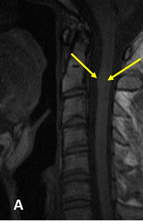 Cavernous Malformation CM Of The Spine MRI Online Is Now Medality