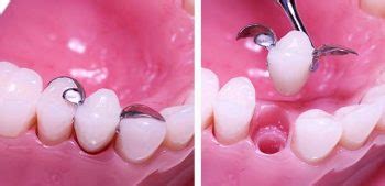 Options For Replacing A Single Missing Tooth The Denture Implant Clinic