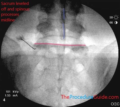 Fluoroscopic Guided Lumbar Medial Branch Block (LMBB) - Technique and ...