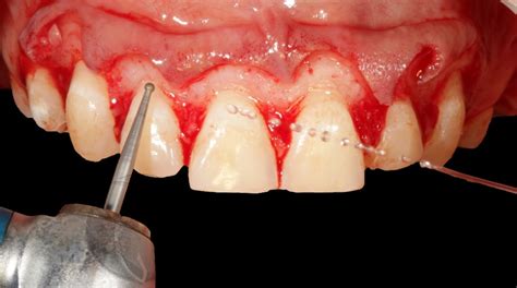 Transforma O De Sorriso Gengival Atrav S De Aumento De Coroa Cl Nica E