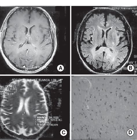 Gliosarcoma Secuencias Axiales T Con Gadolinio A Y Flair B